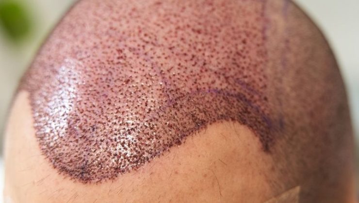 Saç Ekimi ve Estetik Tedaviler: The Hair Clinic’te Mükemmel Bakım
